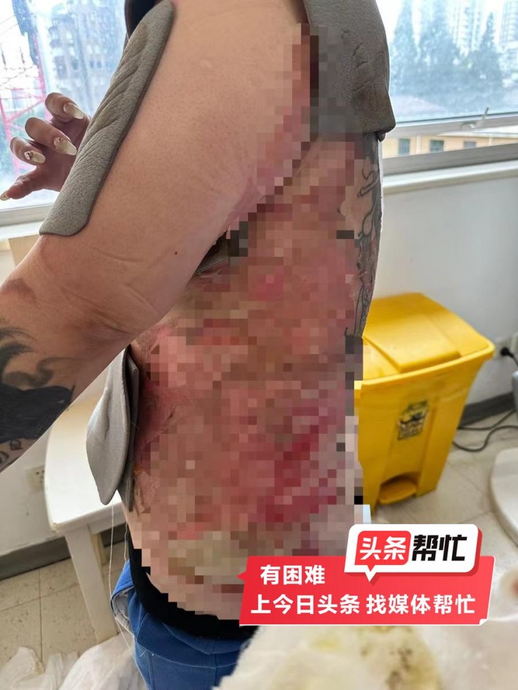 晨意幫忙丨上海女子拔火罐被燙傷需移植豬皮SPA會所:剛開業(yè)比較困難會湊手術費