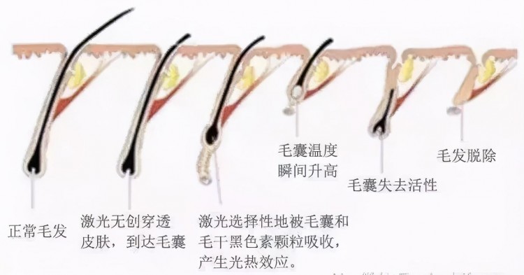 結(jié)腸SPA冰點脫毛光明有生活美容院違法做這些項目被查