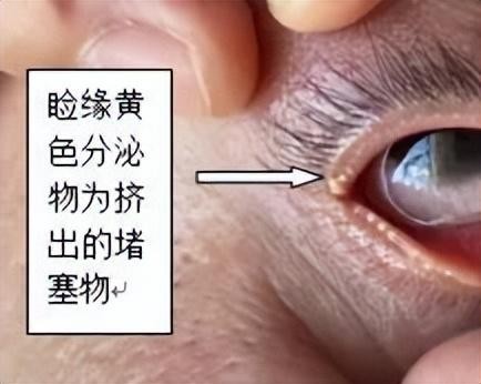 眼部SPA你聽(tīng)過(guò)嗎南昌縣人民醫(yī)院五官科開(kāi)展干眼SPA治療啦