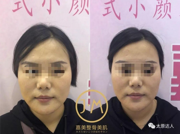 太原現(xiàn)！日式整骨小臉術(shù)！大V明星爆紅全靠它~
