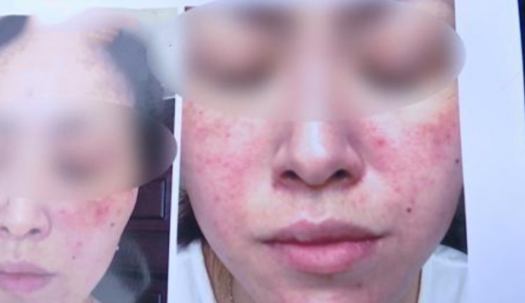 做完面部護理后，整個女人的臉都腫了？美容院：也許是她自己抓住的