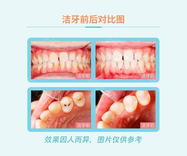 睡眠洗牙｜洗牙黑科技來(lái)給牙齒做個(gè)SPA