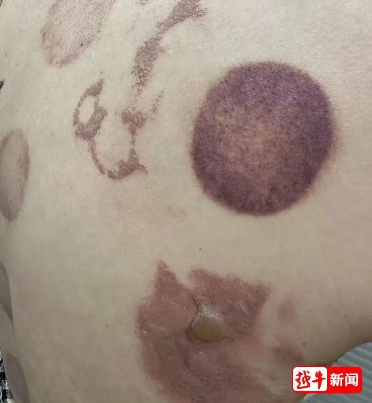 著名的紹興足浴店，女子拔罐事故